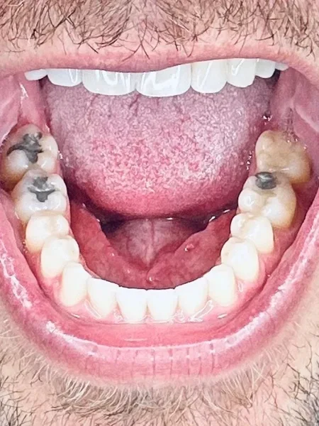 Bigoleteeth14